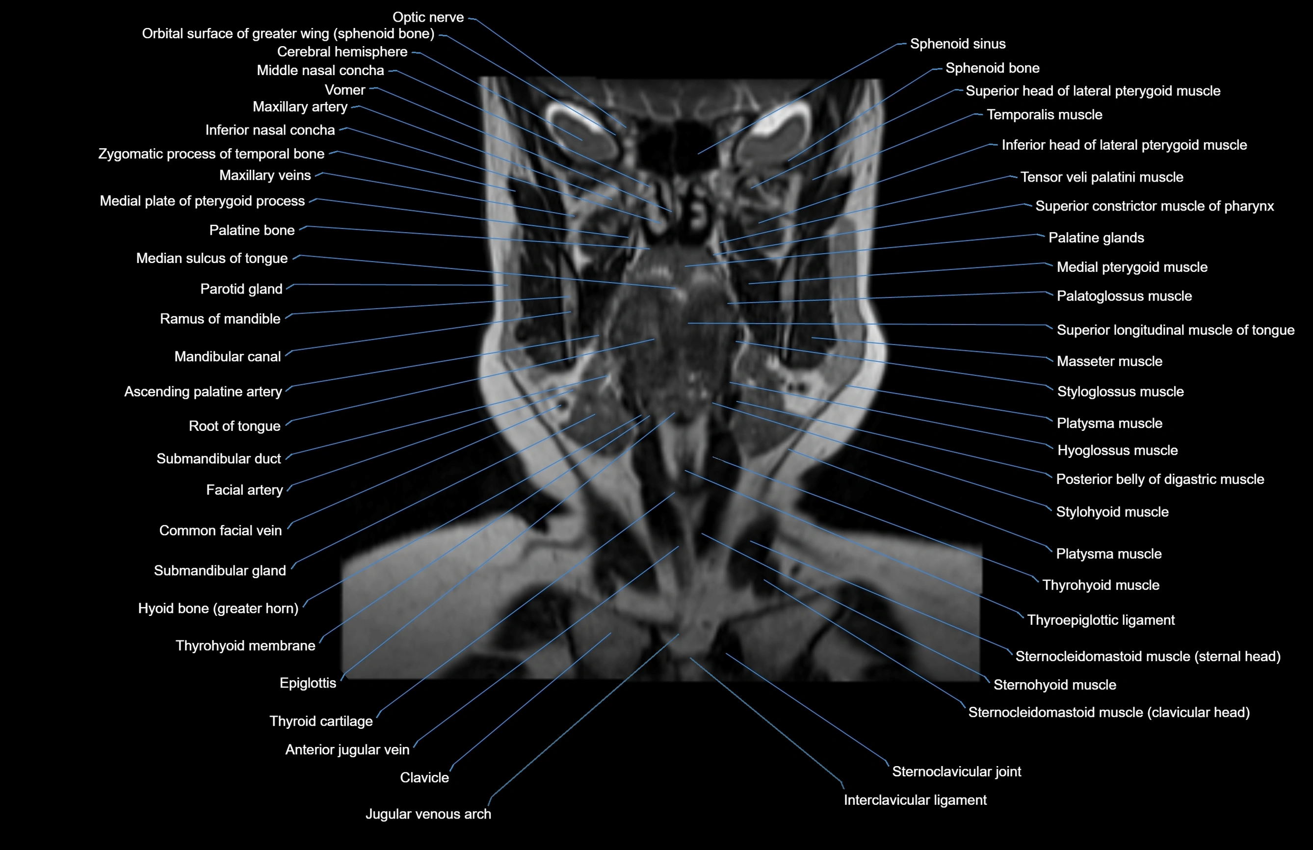 Neck coronal cross sectional MRI anatomy 3T MRI  image-img-00001-00049.webp